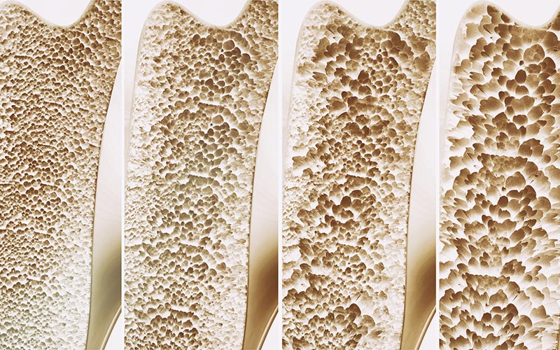 osteopenia-e-osteoporose