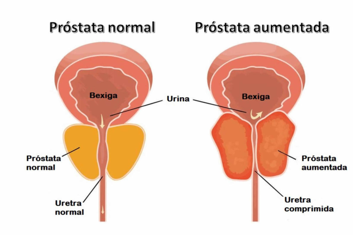5-Aumento-da-próstata